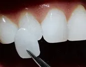 Porcelain-veneers1